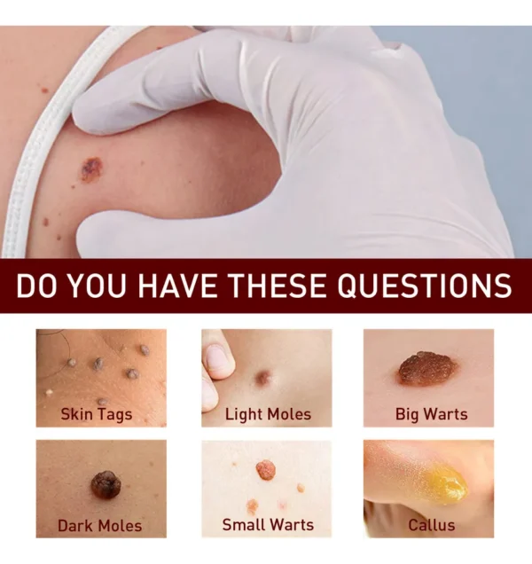 Eliminación De Verrugas Lunares Lapiz 3ml - Imagen 7