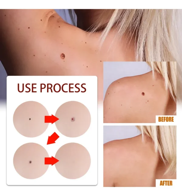 Eliminación De Verrugas Lunares Lapiz 3ml - Imagen 2