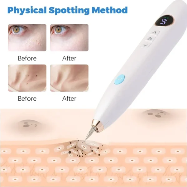 Plasma Pen Lápiz Elimina Verrugas, Lunares, etc - Imagen 4