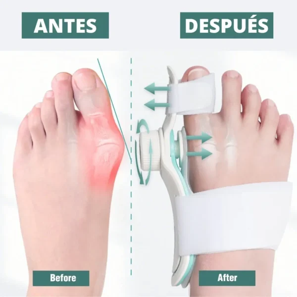 Corrector De Juanetes Graduable - Imagen 4