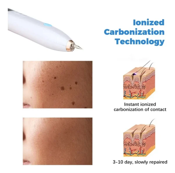 Plasma Pen Lápiz Elimina Verrugas, Lunares, etc - Imagen 2